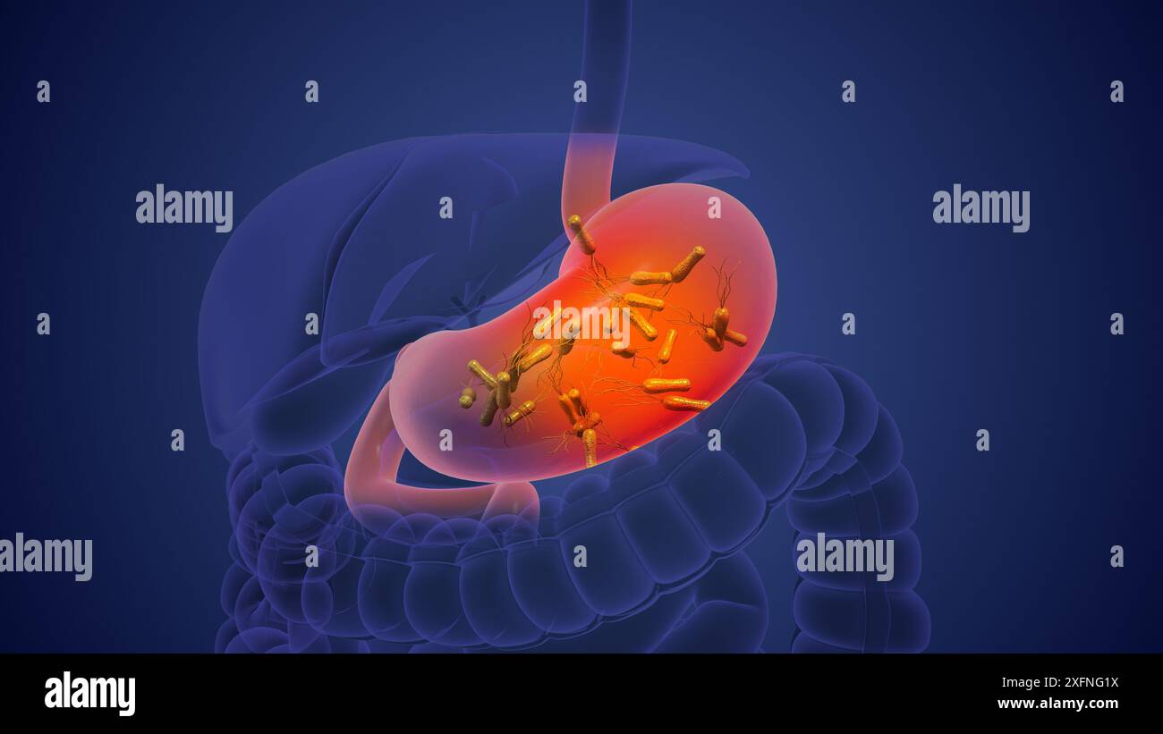 Helicobacter pylori verursacht chronische Entzündungen und Magenkrebs Stockfoto