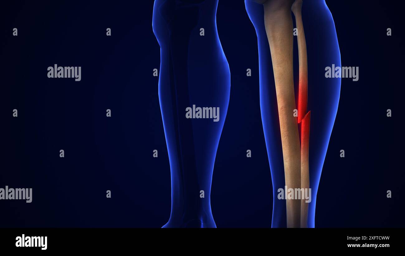 Knochenbruchschmerz-medizinisches Konzept Stockfoto