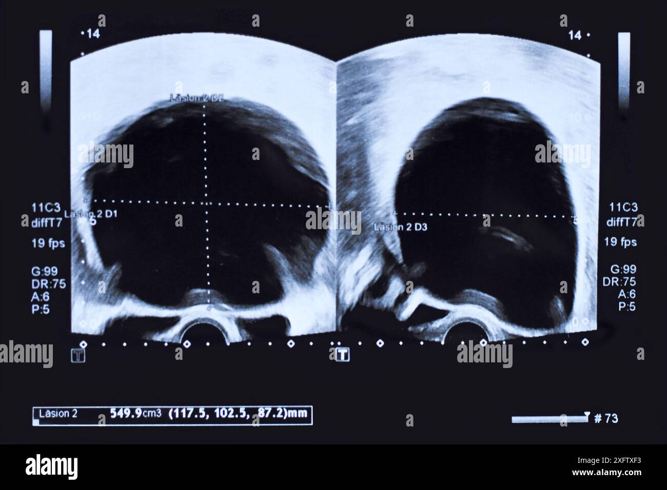 Sonographische Darstellung grosser Rundzysten im Unterbauch einer Frau, gedruckt auf einem Stück Papier Stockfoto