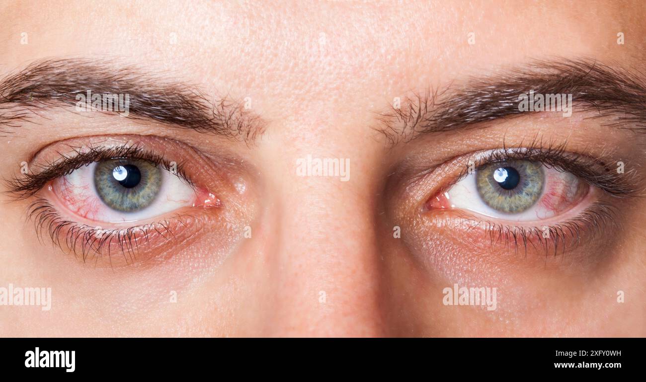 Close Up von zwei Augen irritiert rotes Blut. Stockfoto