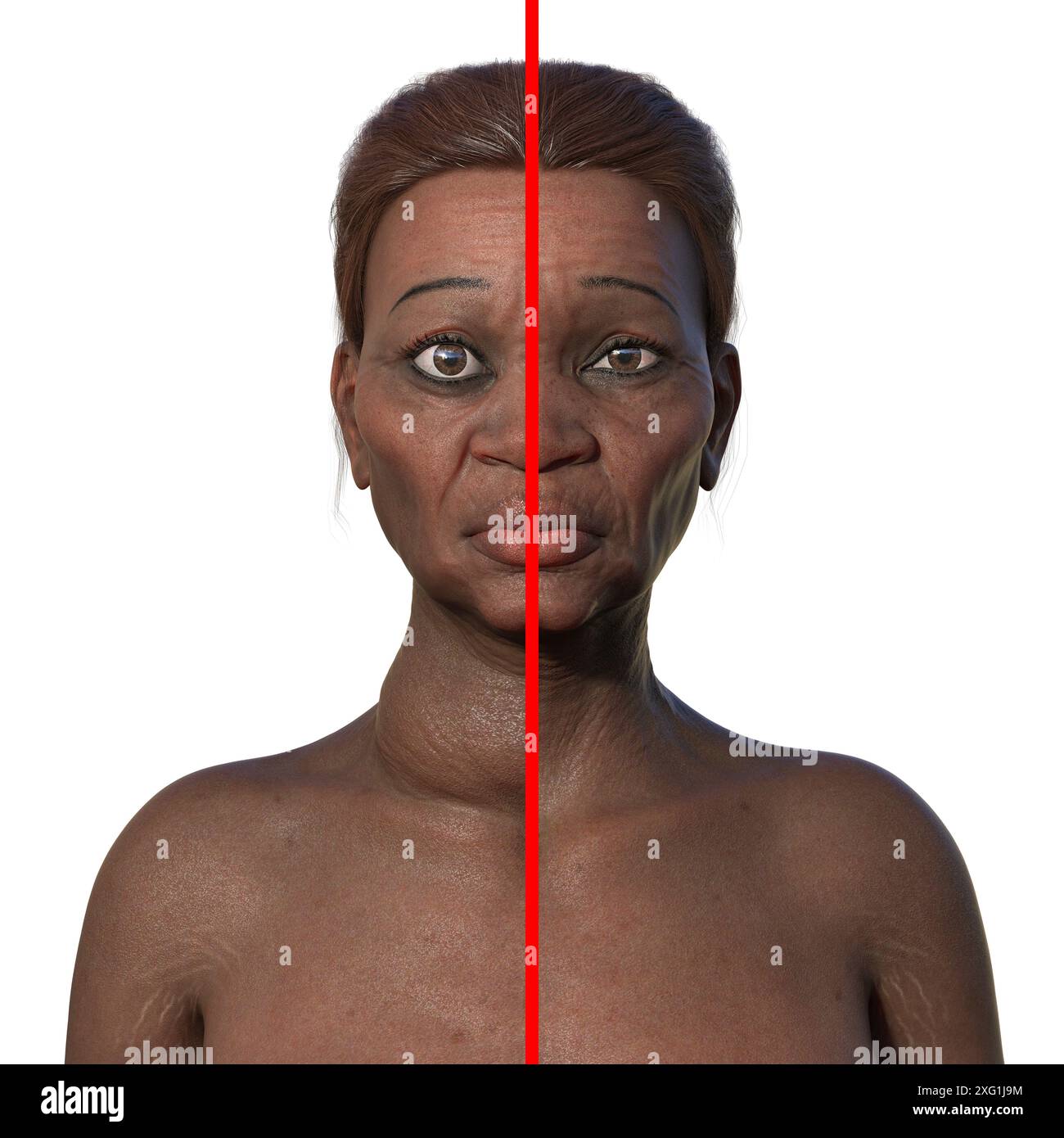 Abbildung einer älteren Frau mit Morbus Basedow (links), die eine vergrößerte Schilddrüse (Struma, Nackenbasis) und abnorme Vorwölbung der Augen (Exophthalmus) verursacht, im Vergleich zu derselben gesunden Frau (rechts). Morbus Basedow ist eine Autoimmunerkrankung, bei der Antikörper produziert werden, die die Schilddrüse veranlassen, übermäßige Hormone zu produzieren. Stockfoto