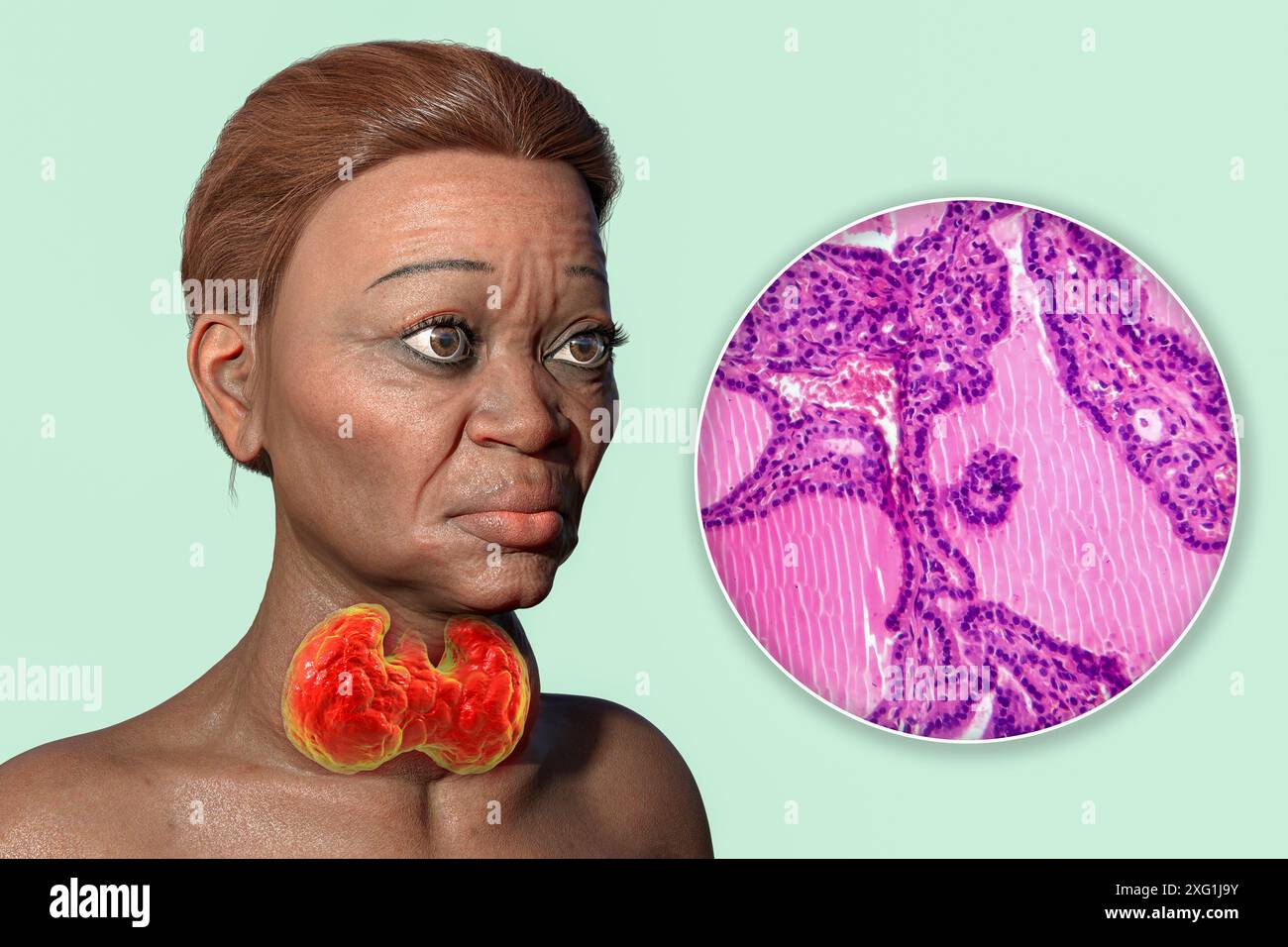 Illustration einer Frau mit Morbus Basedow und Nahaufnahme des betroffenen Schilddrüsengewebes. Morbus Basedow kann zur Entwicklung einer vergrößerten Schilddrüse (Struma, Nackenbasis) führen und eine abnorme Vorwölbung der Augen (Exophthalmus) verursachen. Morbus Basedow ist eine Autoimmunerkrankung, bei der Antikörper produziert werden, die die Schilddrüse veranlassen, übermäßige Hormone zu produzieren. Stockfoto