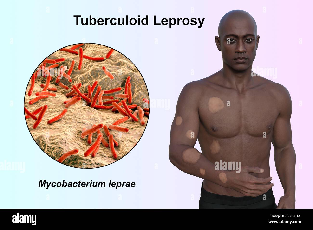 Illustration eines Mannes mit hypopigmentierten Läsionen an Arm und Rumpf durch tuberkuloide Lepra und Nahaufnahme des ursächlichen Mycobacterium leprae-Bakteriums. Stockfoto