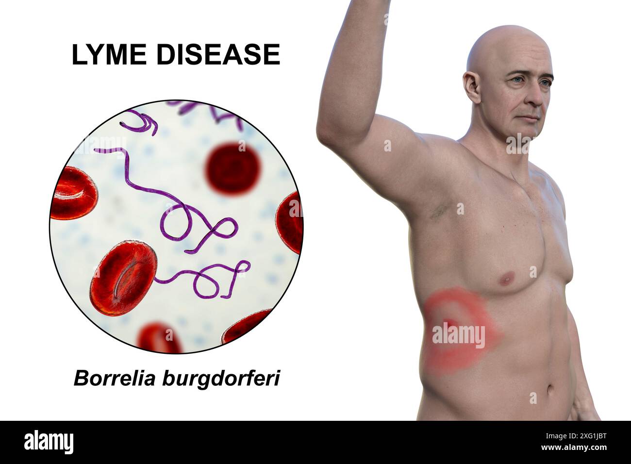 Abbildung zeigt Erythema migrans, ein charakteristischer Hautausschlag bei Patienten mit Lyme-Borreliose gesehen, und eine Nahaufnahme der ursächlichen Borrelia burgdorferi Bakterien. Dieses Bakterium wird typischerweise über einen Insektenvektor, wie z. B. eine Zecke, auf den Menschen übertragen. Stockfoto