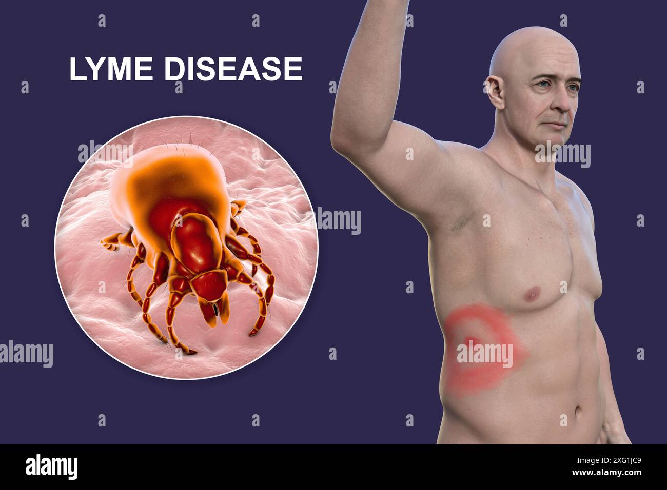 Abbildung zeigt Erythema migrans, ein charakteristischer Hautausschlag bei Patienten mit Lyme-Borreliose gesehen, und eine Nahaufnahme einer Zecke. Lyme-Borreliose wird durch Borrelia burgdorferi Bakterien verursacht. Es wird typischerweise über einen Insektenvektor auf den Menschen übertragen, wobei Zecken die häufigste sind. Stockfoto