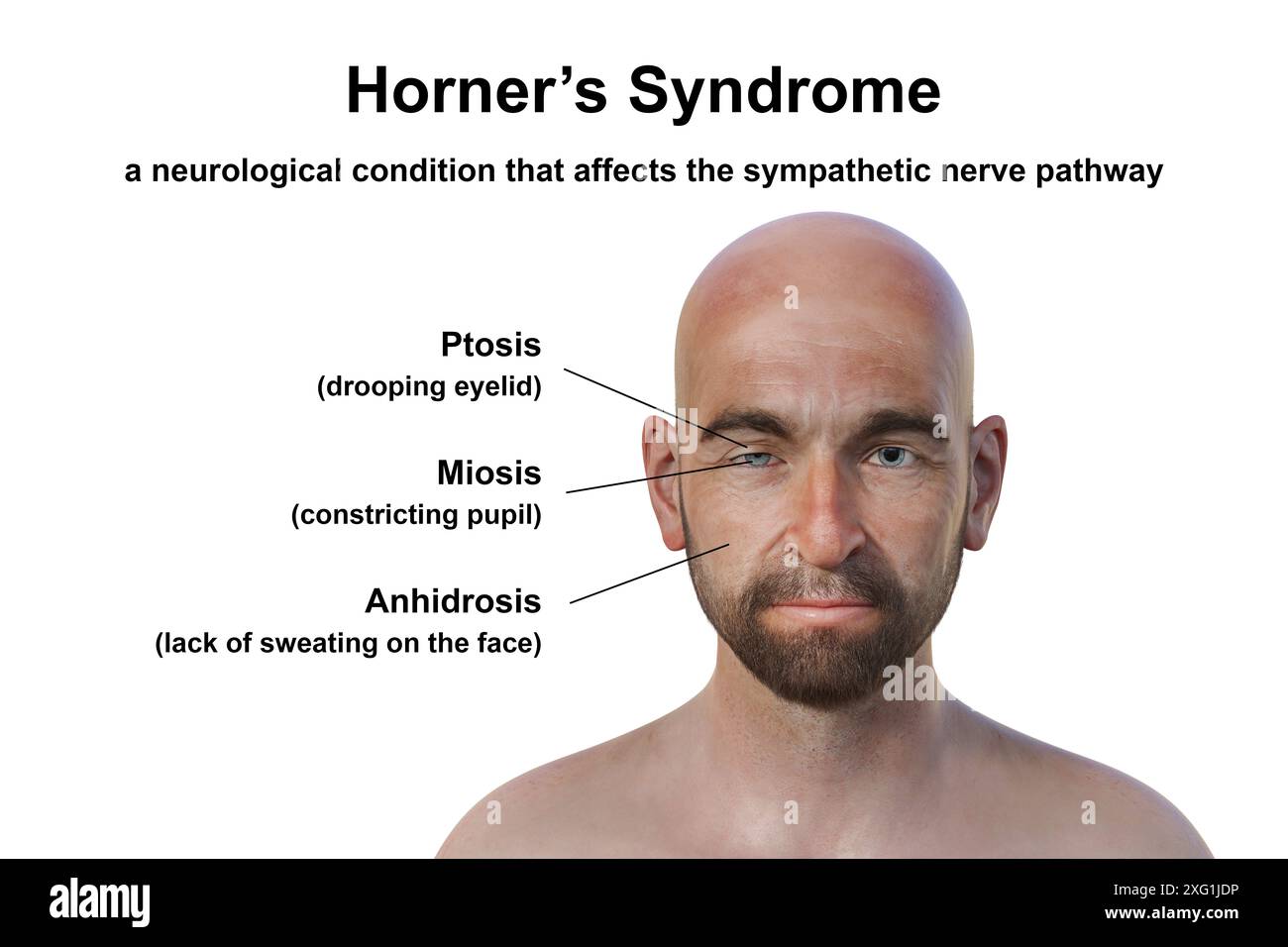 Abgebildete Illustration eines Mannes mit Horner-Syndrom. Dies ist eine seltene Erkrankung, die auf einer Seite des Gesichts aufgrund einer Störung des sympathischen Nervs Ptosis (Tropfen des Augenlids), Miosis (Pupillenverengung) und Anhidrose (Schwitzen) verursacht. Stockfoto