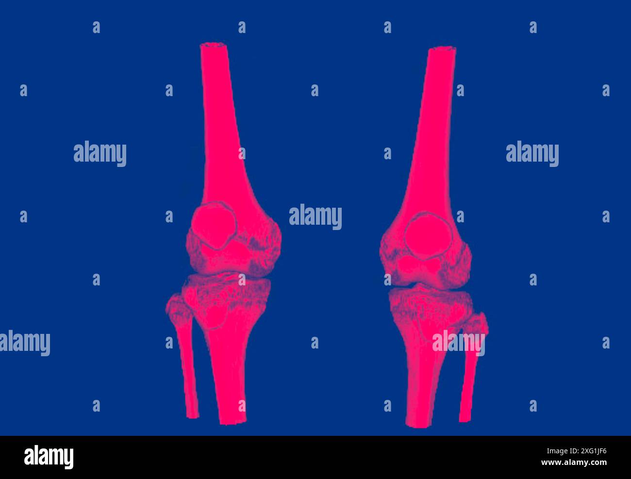 Farbige Computertomographie (CT) gesunder Knie. Stockfoto