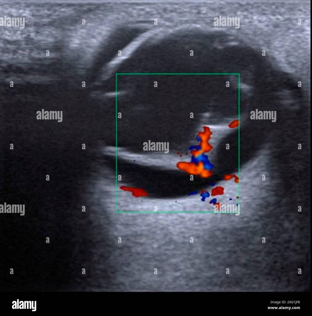 Ultraschalluntersuchung eines Patienten mit abgelöster Netzhaut (innerhalb des grünen Quadrats). Die Netzhaut ist das lichtempfindliche Gewebe im hinteren Teil des Auges. Ablösung bedeutet, dass er sich von den Gewebeschichten um ihn herum entfernt hat. Die blauen und roten Farben weisen auf eine Vaskularisation um die Verletzung hin. Stockfoto