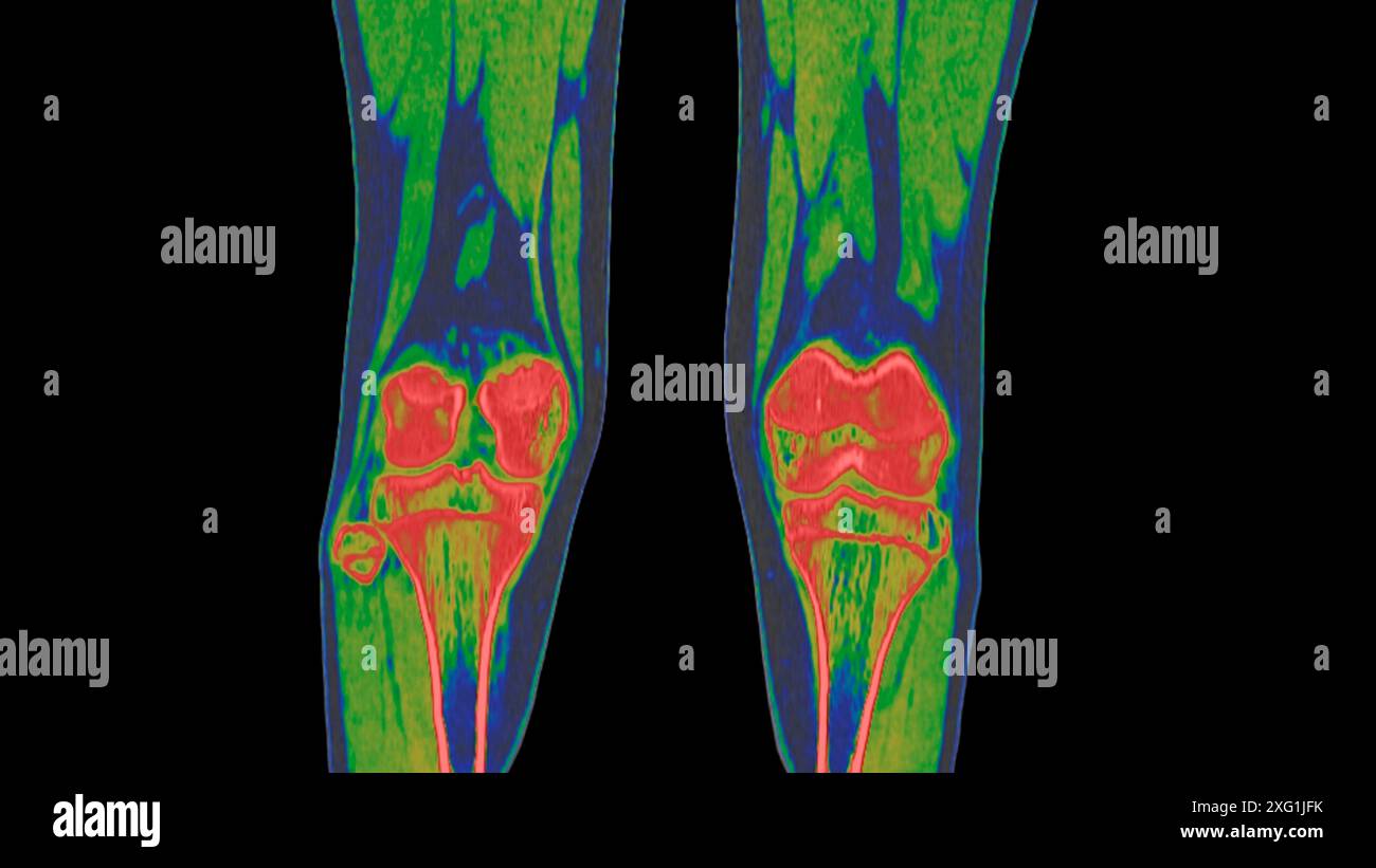 Farbige Computertomographie (CT) gesunder Knie. Stockfoto