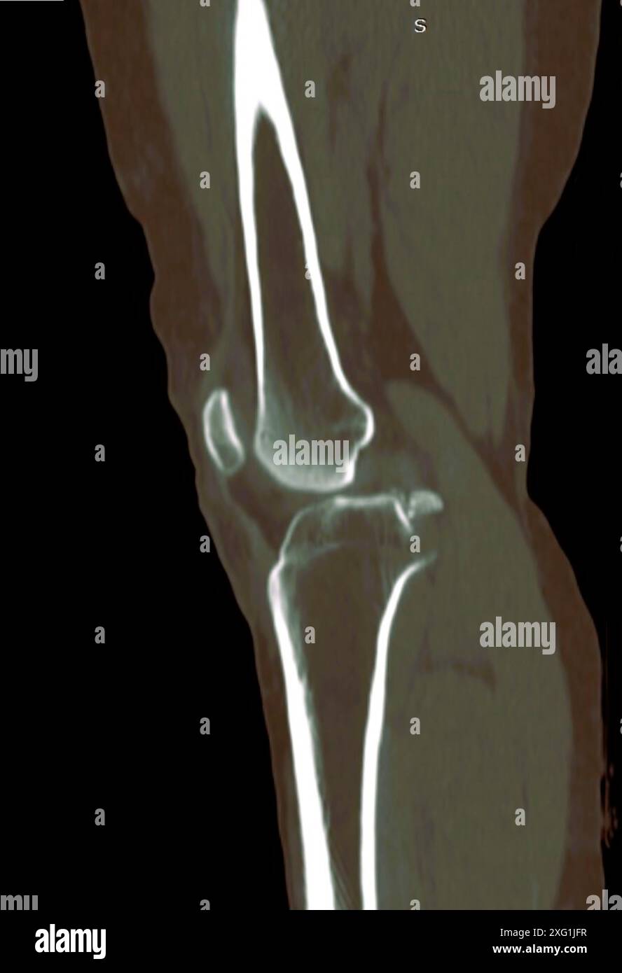 Farbige Computertomographie (CT) am Knie eines Patienten nach einem Autounfall. Das hintere Kreuzband (PCL) hat sich von der Tibia (Kälberknochen, unten) getrennt, sichtbar durch das isolierte Knochenfragment links. Diese Verletzung tritt häufig bei Verkehrsunfällen auf und erfordert in der Regel eine Operation. Stockfoto