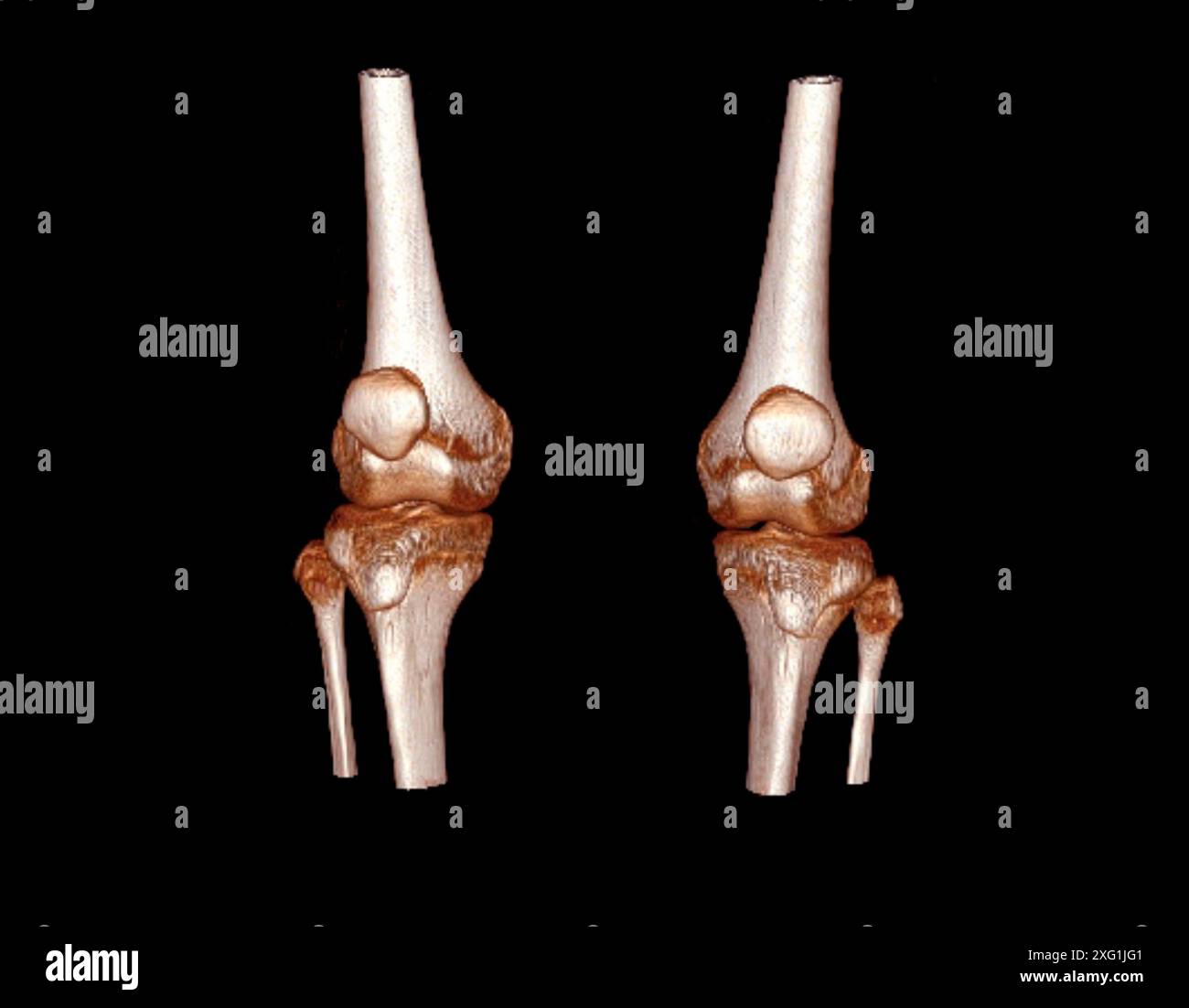 Farbige Computertomographie (CT) gesunder Knie. Stockfoto