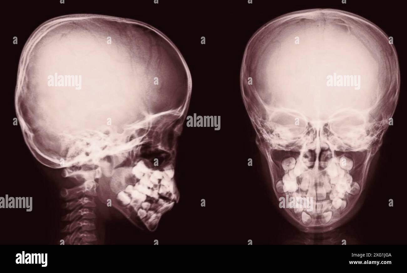 Röntgenaufnahmen eines gesunden Schädels aus anteriorer (Front-) und lateraler (seitlicher) Sicht. Stockfoto