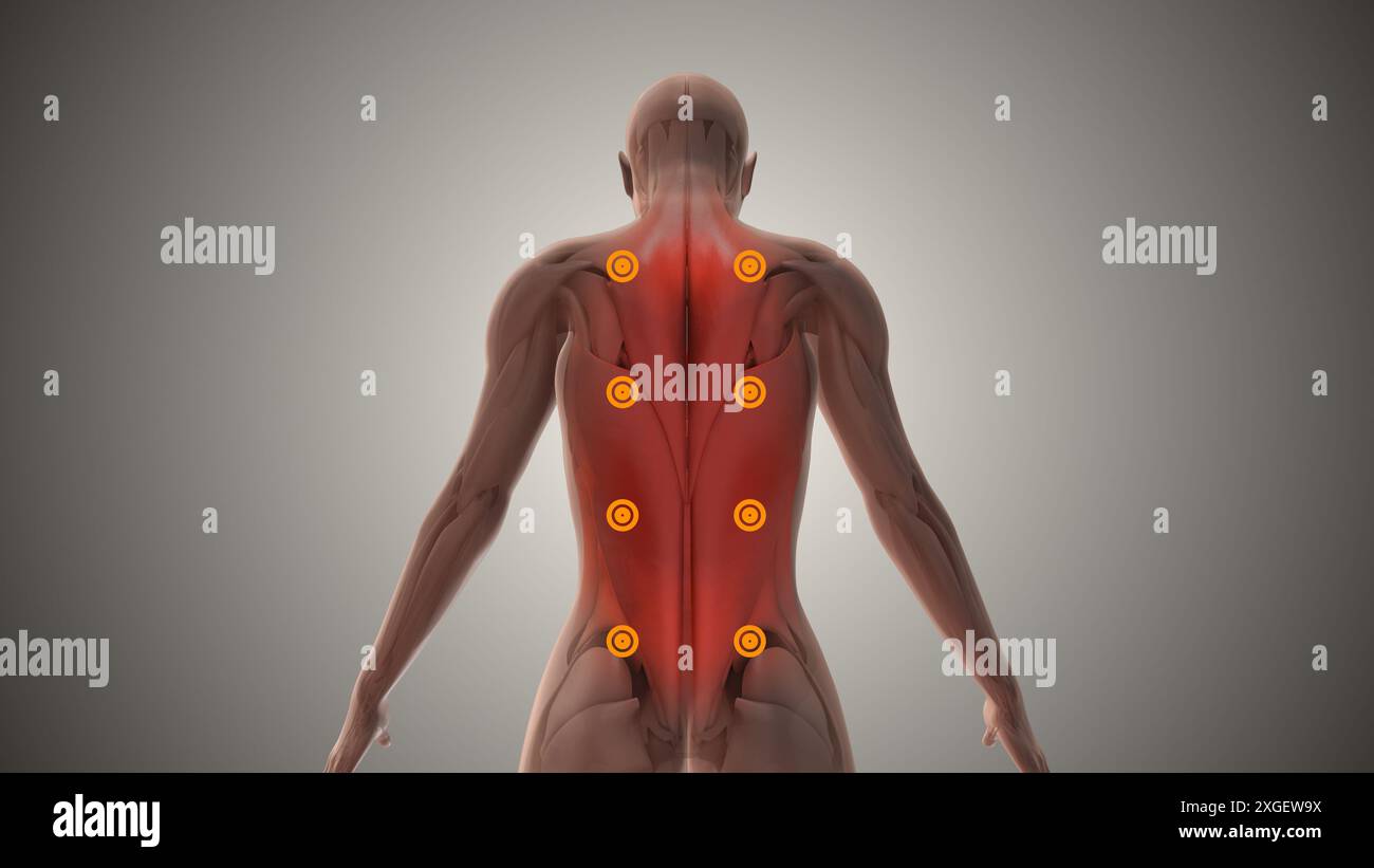 Myofasziales Schmerzsyndrom oder chronische Schmerzstörung Stockfoto