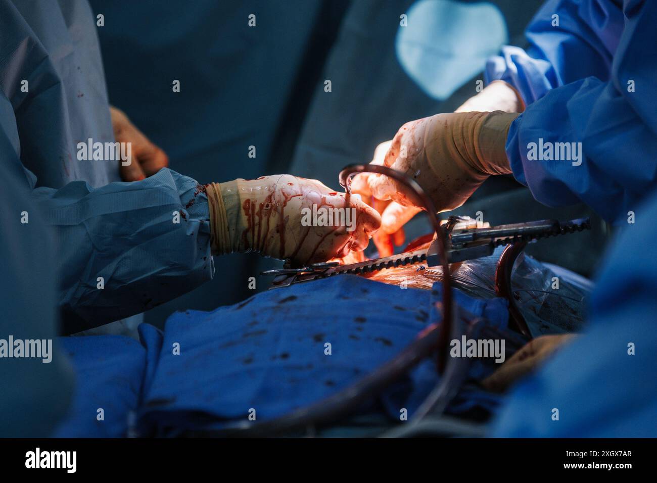 Eine Nahaufnahme von Chirurgen, die komplexe Herzoperationen in einem sterilen Operationssaal durchführen Stockfoto