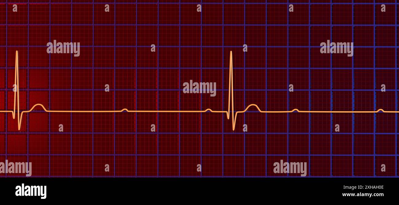 Abbildung eines Elektrokardiogramms (EKG) mit Darstellung eines kompletten Herzblocks (3. Atrioventrikulärer Block). Das EKG zeigt eine vollständige Dissoziation zwischen dem Vorhof- und dem Ventrikelrhythmus. Stockfoto