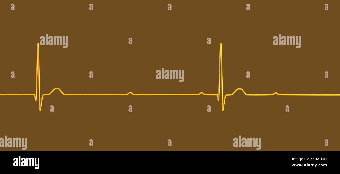 Abbildung eines Elektrokardiogramms (EKG) mit Darstellung eines kompletten Herzblocks (3. Atrioventrikulärer Block). Das EKG zeigt eine vollständige Dissoziation zwischen dem Vorhof- und dem Ventrikelrhythmus. Stockfoto