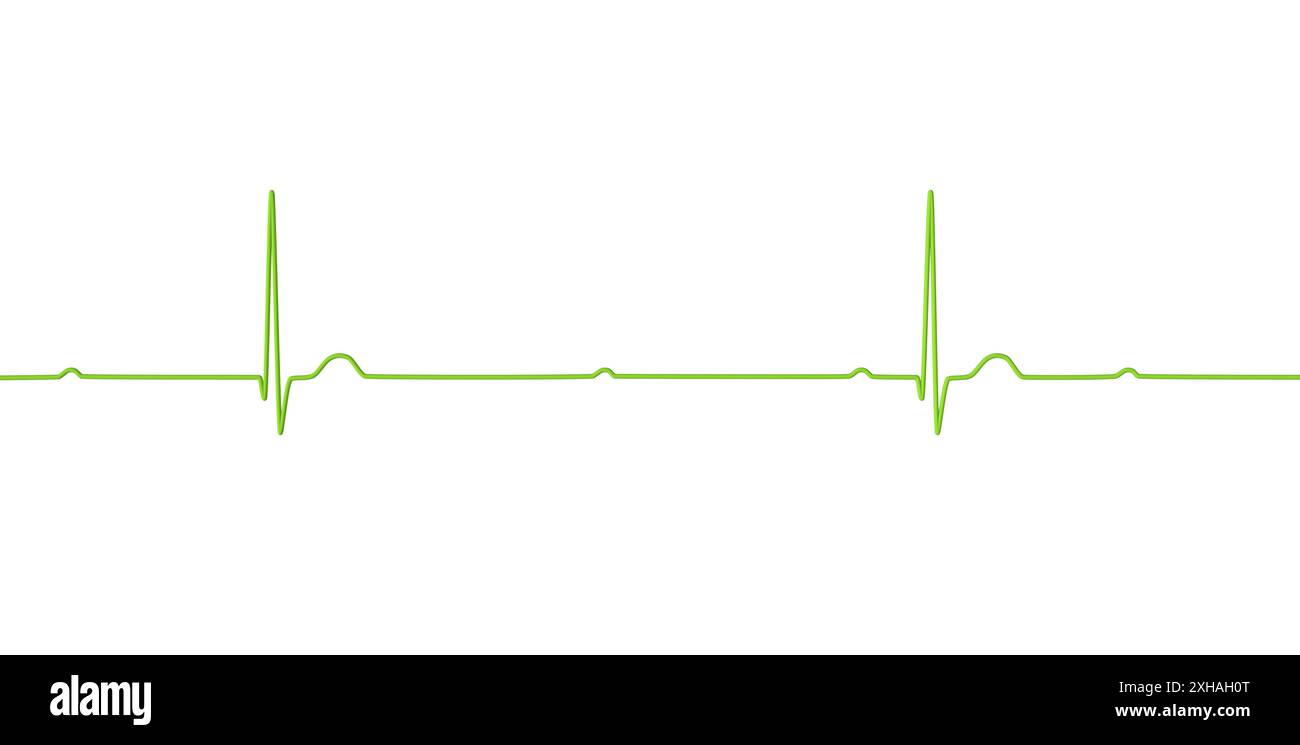 Abbildung eines Elektrokardiogramms (EKG) mit Darstellung eines kompletten Herzblocks (3. Atrioventrikulärer Block). Das EKG zeigt eine vollständige Dissoziation zwischen dem Vorhof- und dem Ventrikelrhythmus. Stockfoto