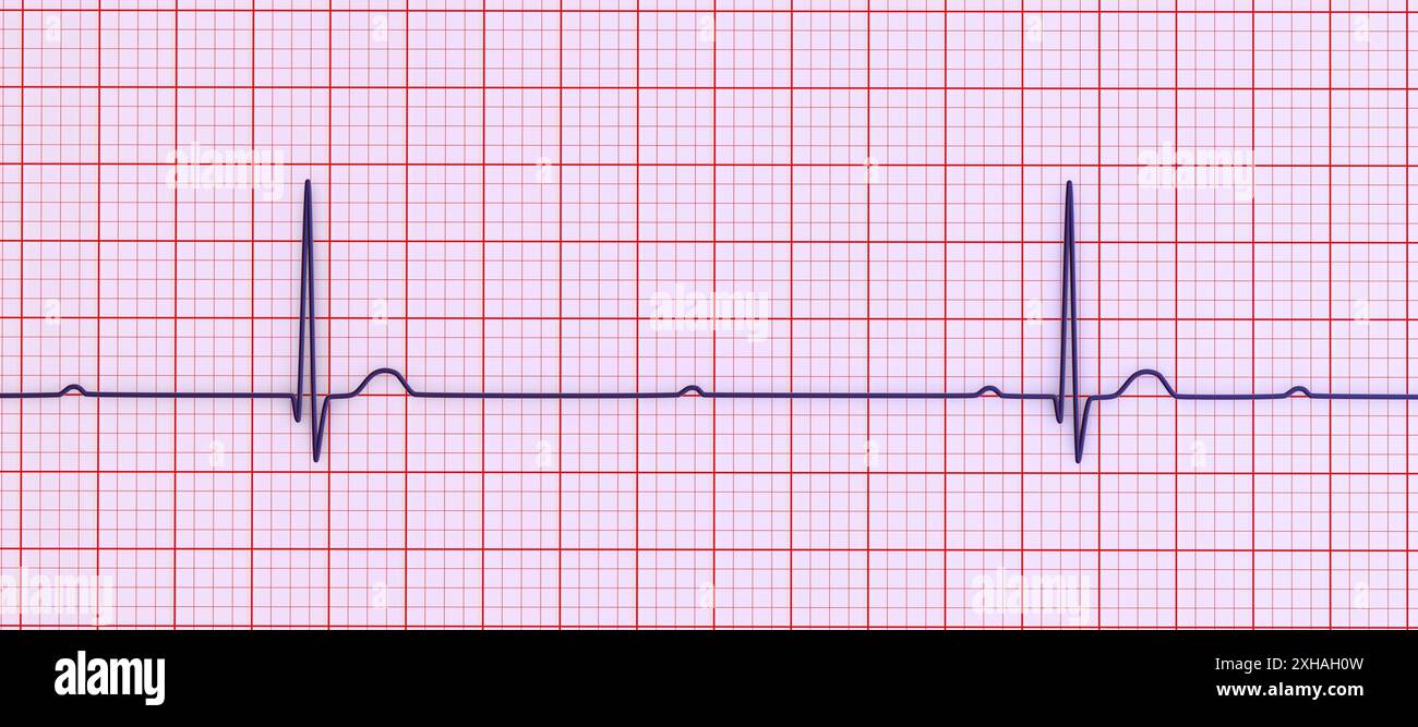 Abbildung eines Elektrokardiogramms (EKG) mit Darstellung eines kompletten Herzblocks (3. Atrioventrikulärer Block). Das EKG zeigt eine vollständige Dissoziation zwischen dem Vorhof- und dem Ventrikelrhythmus. Stockfoto