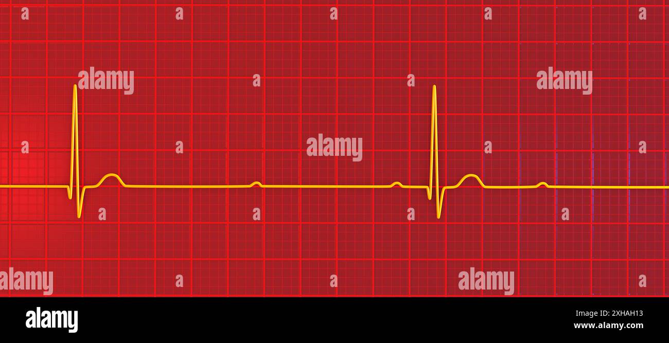 Abbildung eines Elektrokardiogramms (EKG) mit Darstellung eines kompletten Herzblocks (3. Atrioventrikulärer Block). Das EKG zeigt eine vollständige Dissoziation zwischen dem Vorhof- und dem Ventrikelrhythmus. Stockfoto