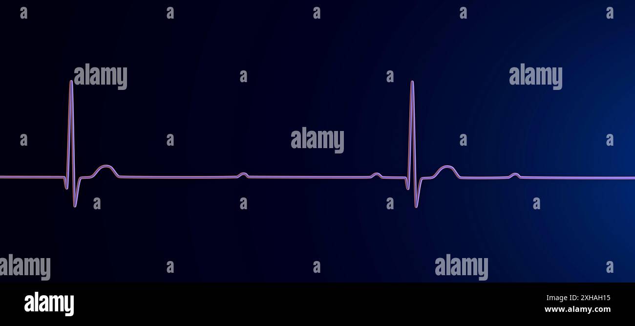 Abbildung eines Elektrokardiogramms (EKG) mit Darstellung eines kompletten Herzblocks (3. Atrioventrikulärer Block). Das EKG zeigt eine vollständige Dissoziation zwischen dem Vorhof- und dem Ventrikelrhythmus. Stockfoto