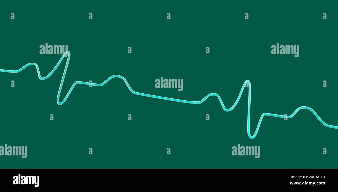 Abbildung eines Elektrokardiogramms (EKG) mit einem Schenkelblock. Dies tritt auf, wenn das elektrische Signal, das das Herz schlägt, durch etwas blockiert oder gestört wird. Das EKG zeigt erweiterte QRS-Komplexe und eine veränderte ventrikuläre Depolarisation. Stockfoto