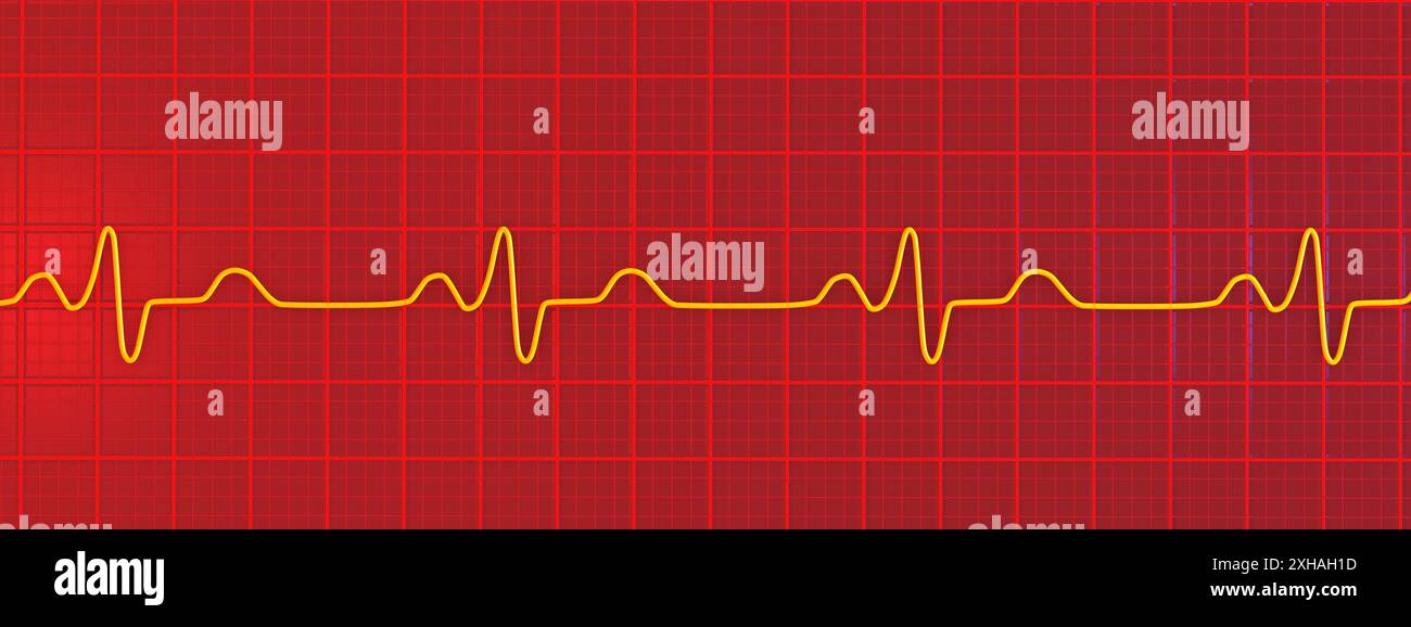 Abbildung eines Elektrokardiogramms (EKG) mit einem Schenkelblock. Dies tritt auf, wenn das elektrische Signal, das das Herz schlägt, durch etwas blockiert oder gestört wird. Das EKG zeigt erweiterte QRS-Komplexe und eine veränderte ventrikuläre Depolarisation. Stockfoto