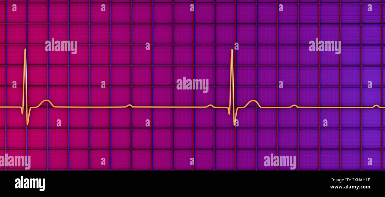 Abbildung eines Elektrokardiogramms (EKG) mit Darstellung eines kompletten Herzblocks (3. Atrioventrikulärer Block). Das EKG zeigt eine vollständige Dissoziation zwischen dem Vorhof- und dem Ventrikelrhythmus. Stockfoto