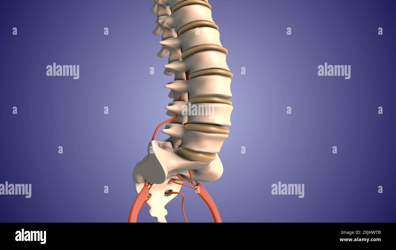 Injektion von Steroiden zur Behandlung von Bandscheibenvorfällen Stockfoto