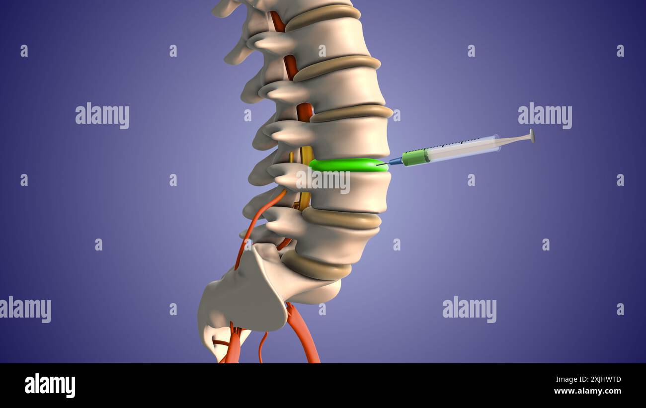 Injektion von Steroiden zur Behandlung von Bandscheibenvorfällen Stockfoto