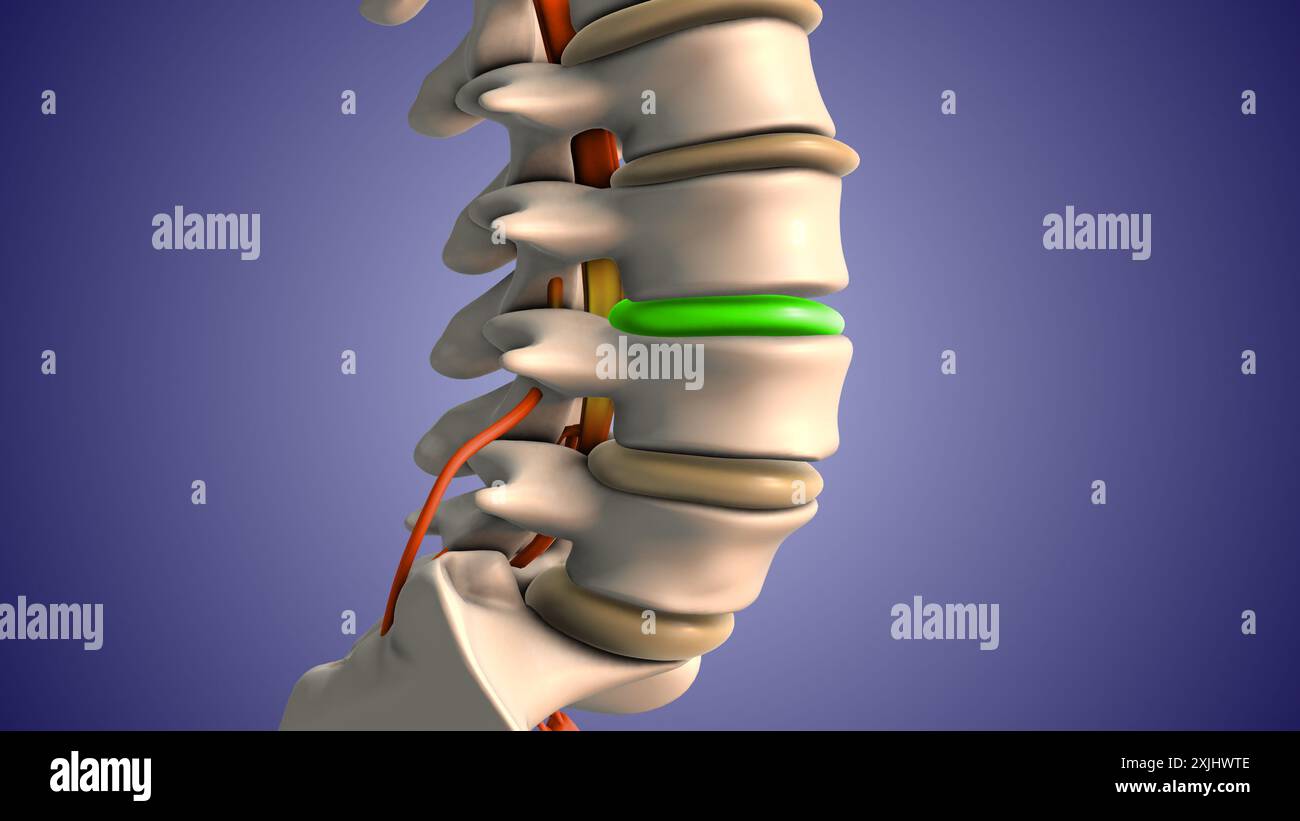 Injektion von Steroiden zur Behandlung von Bandscheibenvorfällen Stockfoto