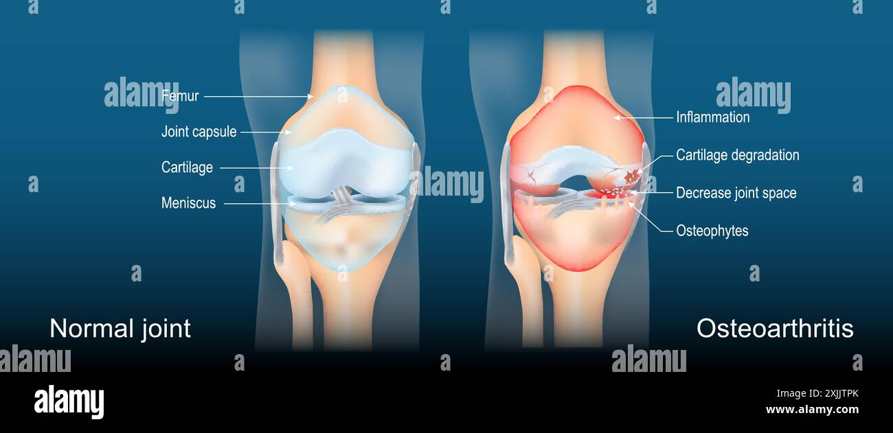 Osteoarthritis. Arthritis ist eine degenerative Gelenkerkrankung. Entzündung, Schwellung und Gelenkschmerzen. Vorderansicht des menschlichen Kniegelenkes mit leuchtender Wirkung. Stock Vektor