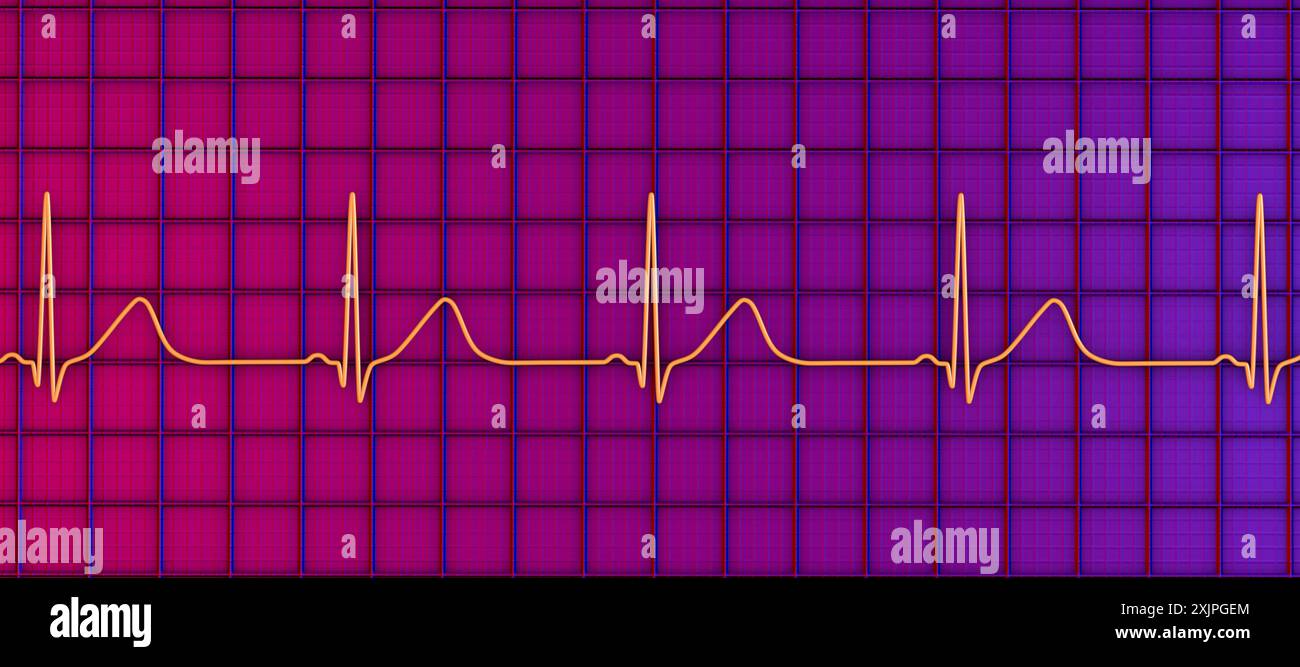 Illustration eines Elektrokardiogramms (EKG) mit verlängertem QT-Intervall mit breiten T-Wellen, charakteristisch für das Long-QT-Syndrom Typ 1. Das Long-QT-Syndrom ist eine erbliche Herzerkrankung, die den Herzschlag beeinflusst und manchmal Ohnmacht oder Krampfanfälle verursachen kann. Stockfoto