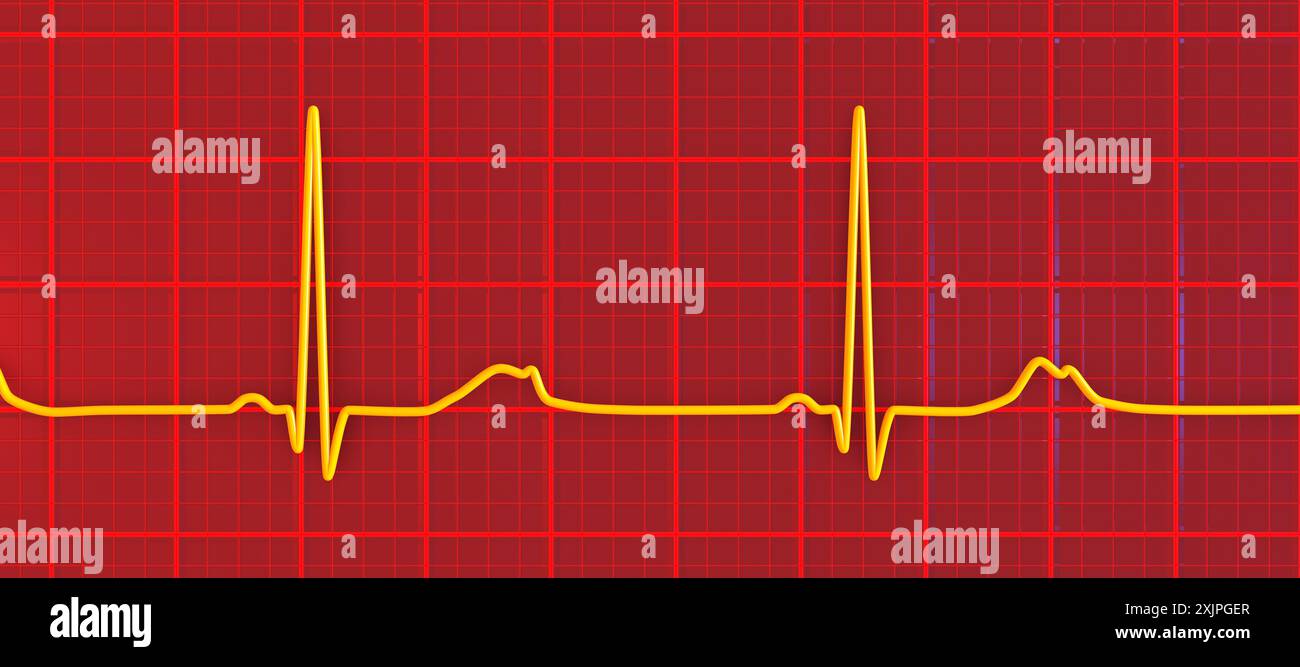 Abbildung eines Elektrokardiogramms (EKG) mit verlängertem QT-Intervall mit gekerbter und niedrigerer Amplitude, charakteristisch für das Long-QT-Syndrom Typ 2. Das Long-QT-Syndrom ist eine erbliche Herzerkrankung, die den Herzschlag beeinflusst und manchmal Ohnmacht oder Krampfanfälle verursachen kann. Stockfoto