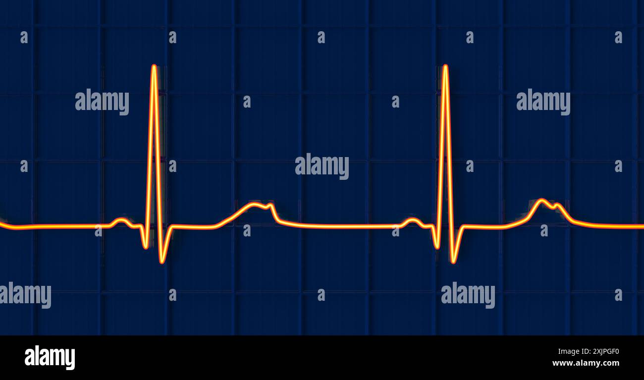 Abbildung eines Elektrokardiogramms (EKG) mit verlängertem QT-Intervall mit gekerbter und niedrigerer Amplitude, charakteristisch für das Long-QT-Syndrom Typ 2. Das Long-QT-Syndrom ist eine erbliche Herzerkrankung, die den Herzschlag beeinflusst und manchmal Ohnmacht oder Krampfanfälle verursachen kann. Stockfoto