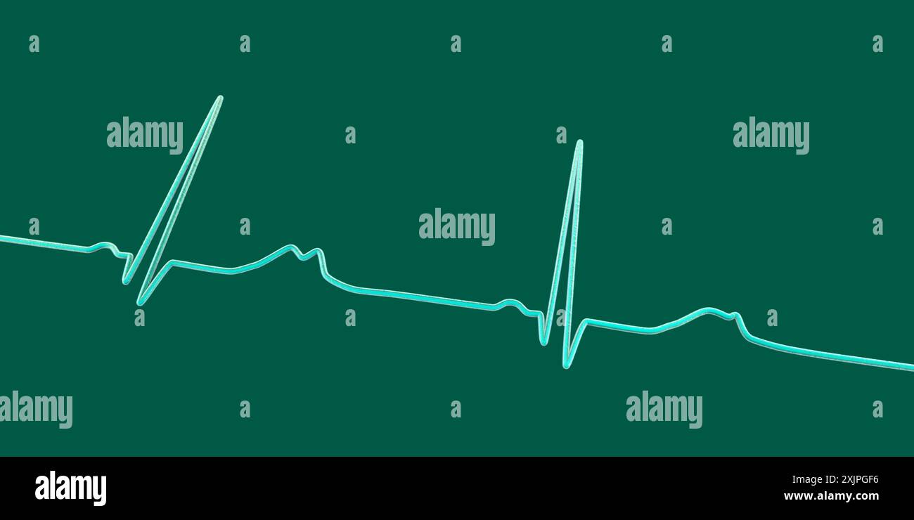 Abbildung eines Elektrokardiogramms (EKG) mit verlängertem QT-Intervall mit gekerbter und niedrigerer Amplitude, charakteristisch für das Long-QT-Syndrom Typ 2. Das Long-QT-Syndrom ist eine erbliche Herzerkrankung, die den Herzschlag beeinflusst und manchmal Ohnmacht oder Krampfanfälle verursachen kann. Stockfoto