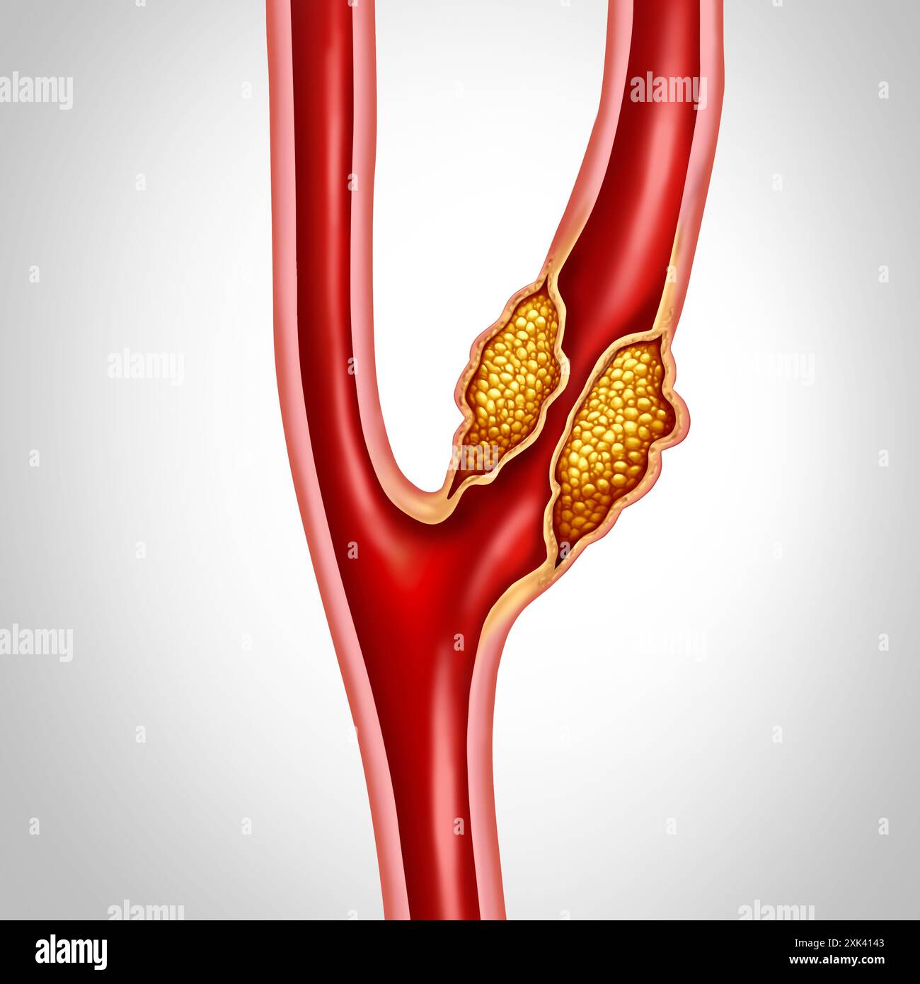 Carotis-Erkrankung als Arterien, die den Blutfluss zum Gehirn bringen, wird durch Atherosklerose unterbrochen, da sich Plaque im blockierten Gefäß ansammelt cau Stockfoto