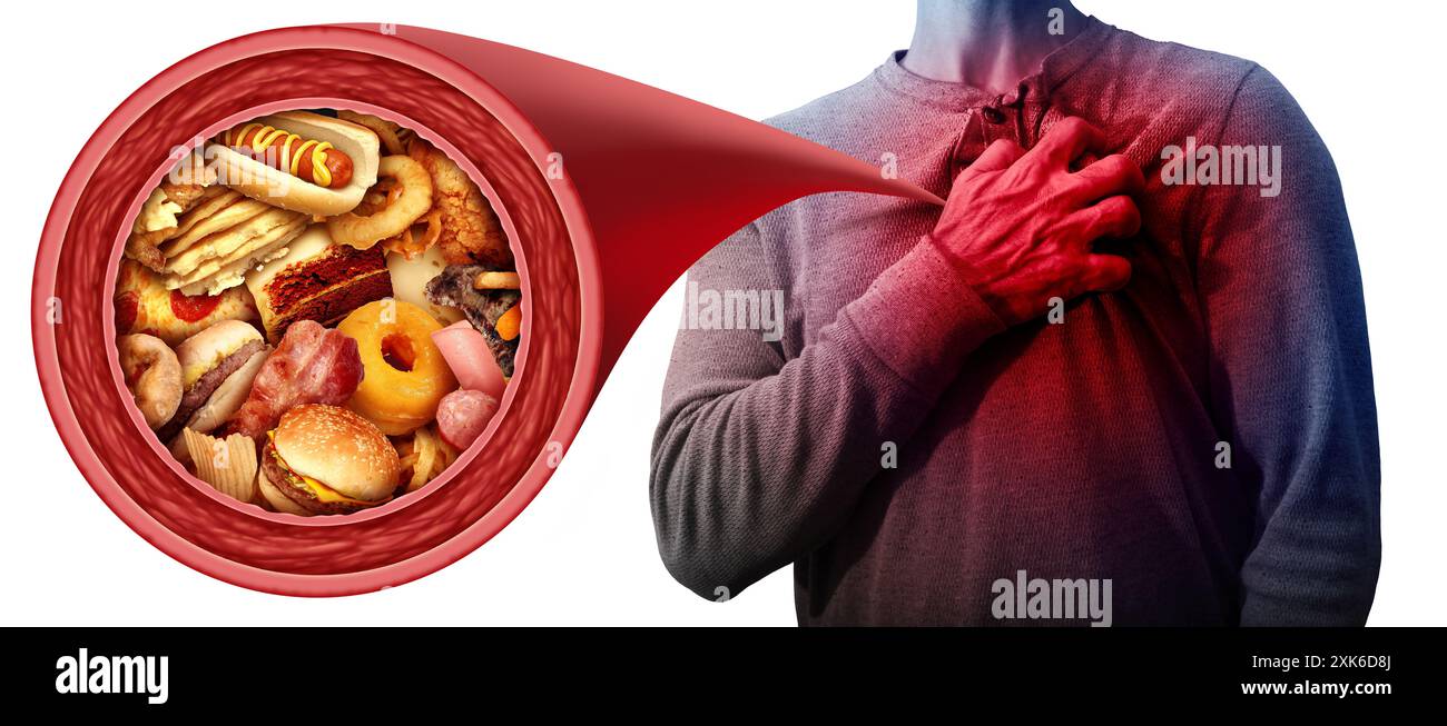 Atherosklerose und diätetisches Fett als Lipoprotein niedriger Dichte oder schlechtes LDL-Cholesterin bei einer Person, die an einem Herzinfarkt aufgrund einer verstopften Koronararterie leidet Stockfoto