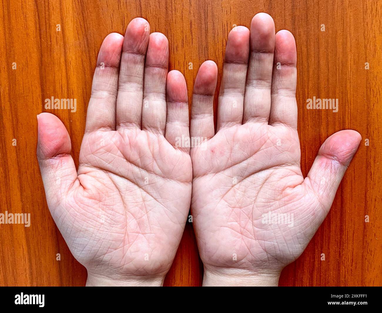 Zyanotische Hände oder periphere Zyanose oder blaue Hände bei südostasiatischen, chinesischen Kind mit angeborener Herzkrankheit. Stockfoto