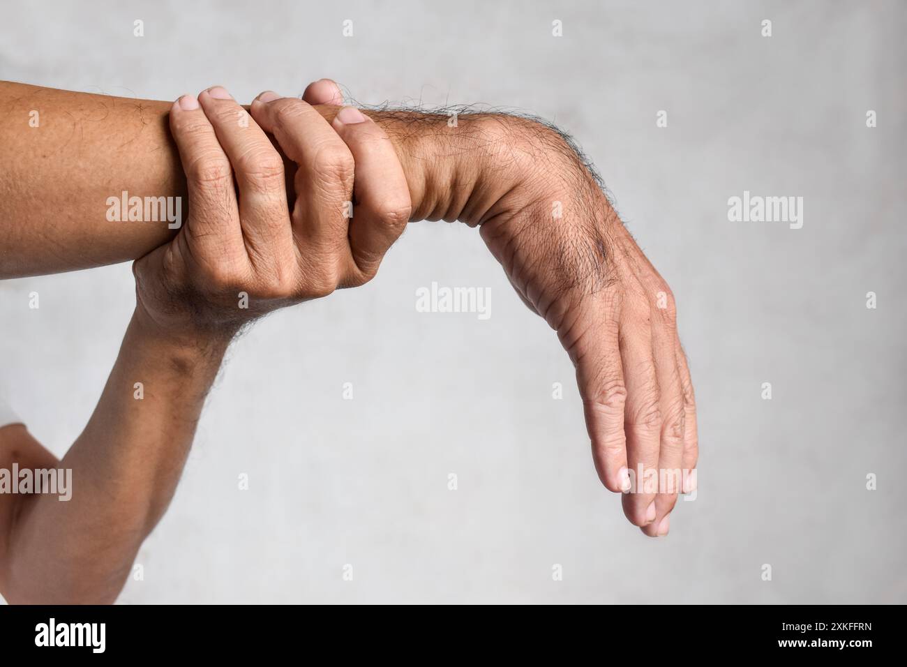 Radiale Nervenverletzung oder Abtropfen des Handgelenks des asiatischen Mannes aus Myanmar. Stockfoto