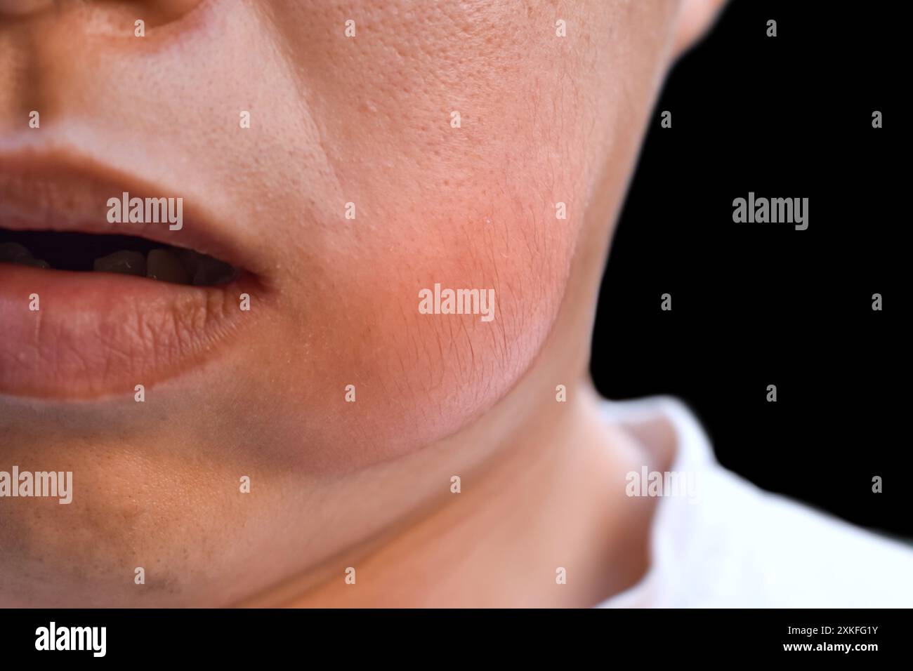 Schwellung an der Wange des jungen Asiaten. Abszessbildung. Stockfoto