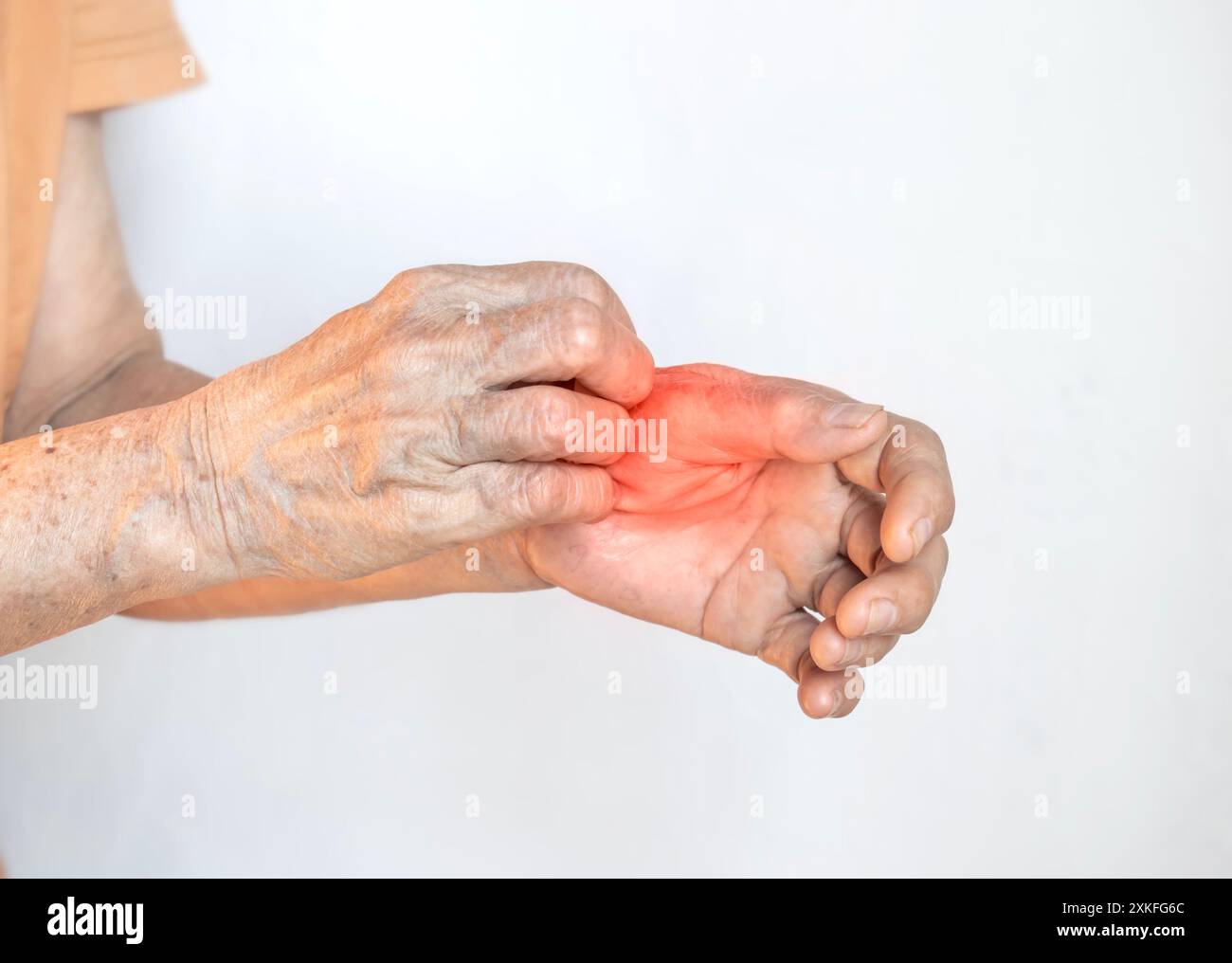 Asiatische Ältere, die sich die Hand kratzt. Konzept juckender Hauterkrankungen wie Krätze, Pilzinfektion, Ekzem, Psoriasis, Hautausschlag, Allergie, etc Stockfoto