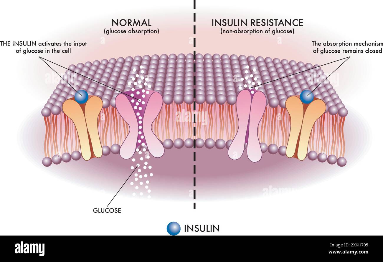 Die medizinische Illustration zeigt auf einfache und schematische Weise den Mechanismus der Insulinresistenz, eine der Ursachen für Typ-2-Diabetes. Stock Vektor