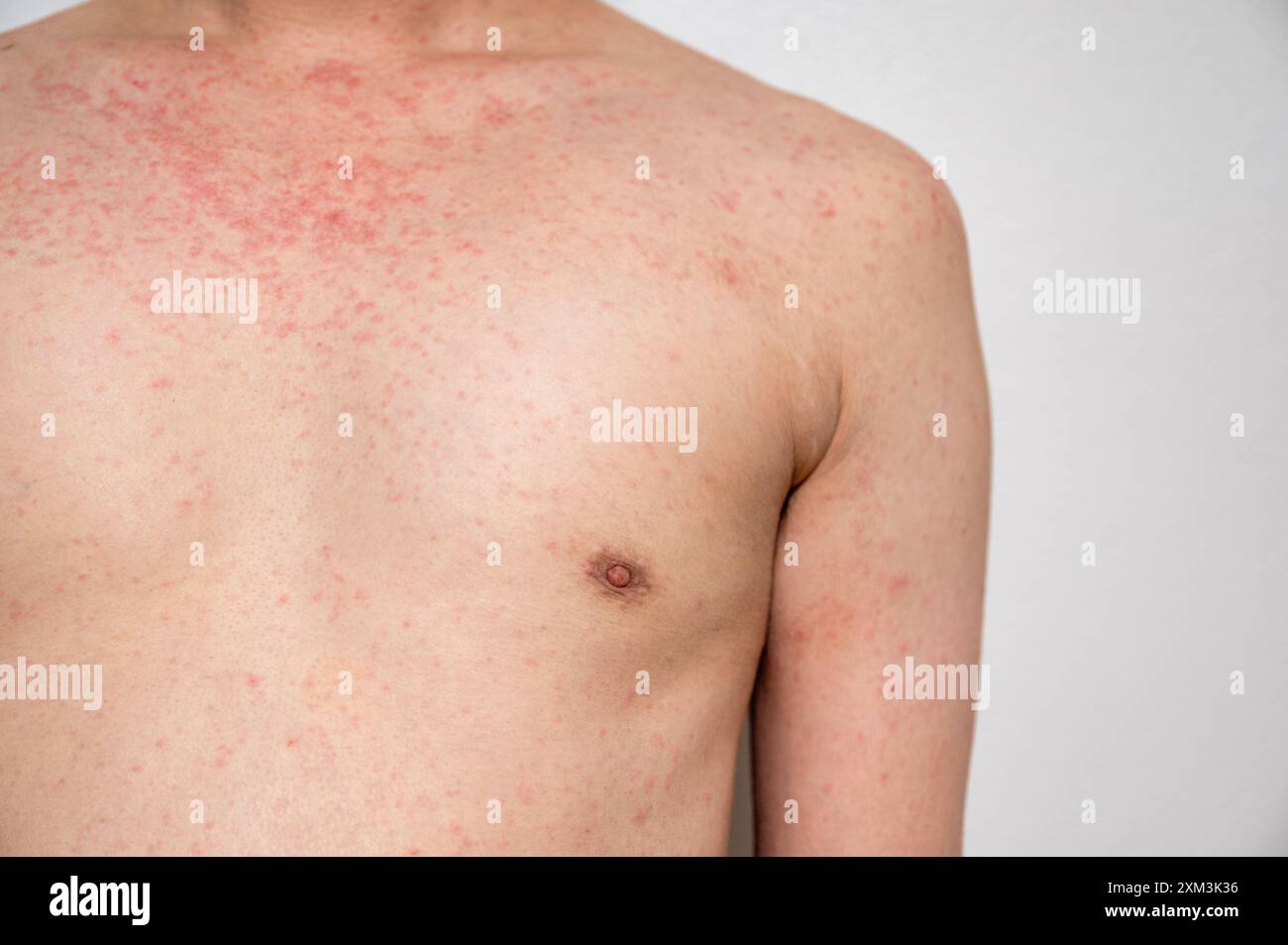 Dermatitis Hautausschlag Viruserkrankung mit Immunschwäche am Körper von jungen erwachsenen asiatischen, Kratzer mit Juckreiz, Masern-Virus, virale Exanthem Stockfoto