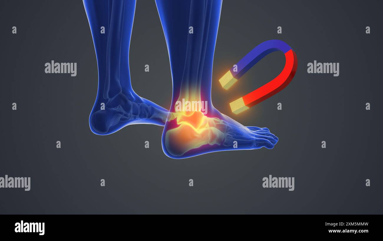 Magnettherapie bei Fussgelenkschmerzen Stockfoto