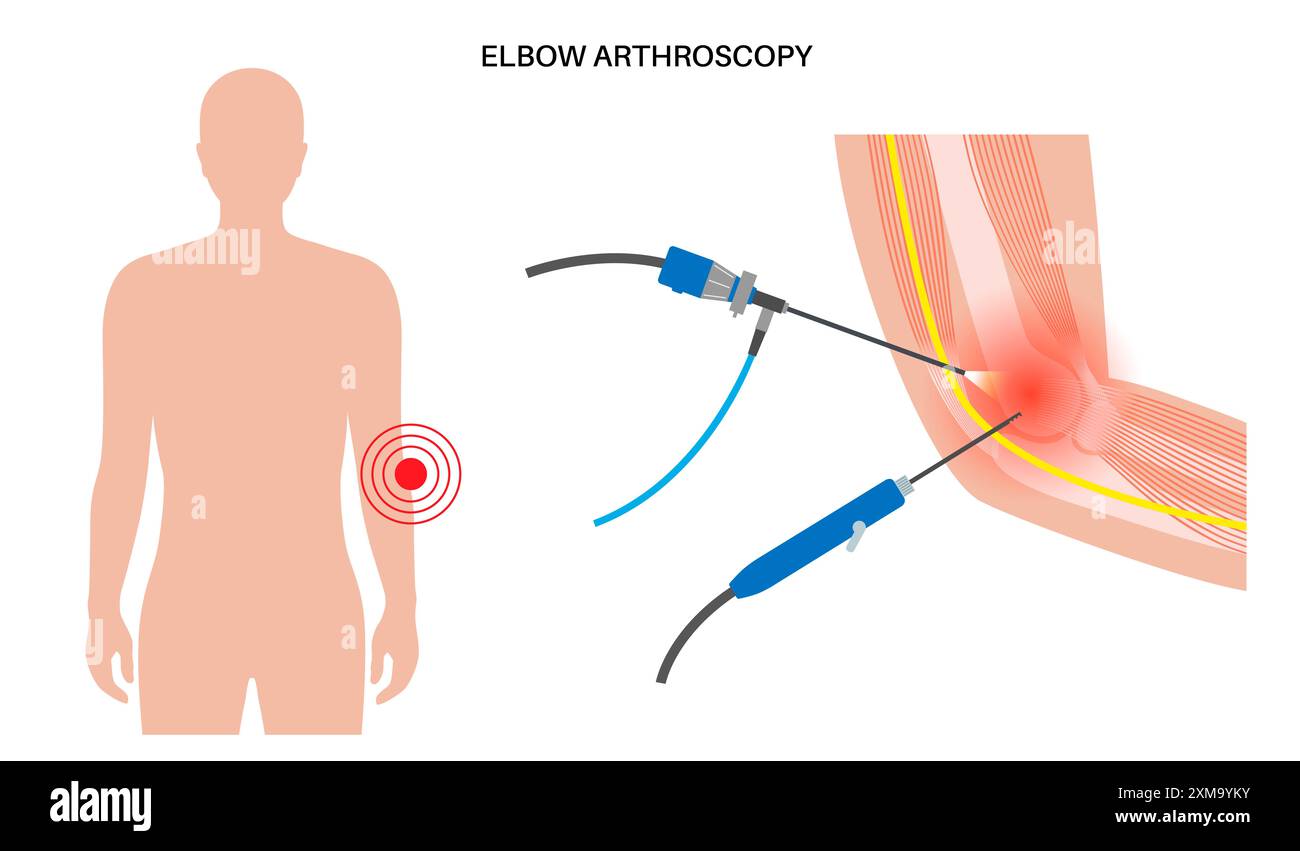 Illustration der Ellenbogenarthroskopie-Chirurgie. Dies ist ein Verfahren zur Diagnose und Behandlung von Gelenkproblemen. Ein Chirurg führt einen schmalen Schlauch, der an einer Glasfaser-Videokamera befestigt ist, durch einen kleinen Schnitt ein. Stockfoto