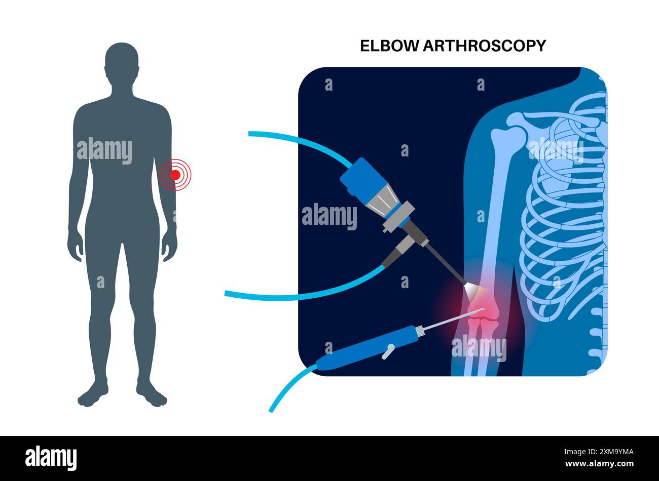 Illustration der Ellenbogenarthroskopie-Chirurgie. Dies ist ein Verfahren zur Diagnose und Behandlung von Gelenkproblemen. Ein Chirurg führt einen schmalen Schlauch, der an einer Glasfaser-Videokamera befestigt ist, durch einen kleinen Schnitt ein. Stockfoto