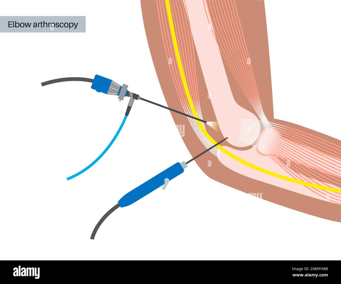 Illustration der Ellenbogenarthroskopie-Chirurgie. Dies ist ein Verfahren zur Diagnose und Behandlung von Gelenkproblemen. Ein Chirurg führt einen schmalen Schlauch, der an einer Glasfaser-Videokamera befestigt ist, durch einen kleinen Schnitt ein. Stockfoto