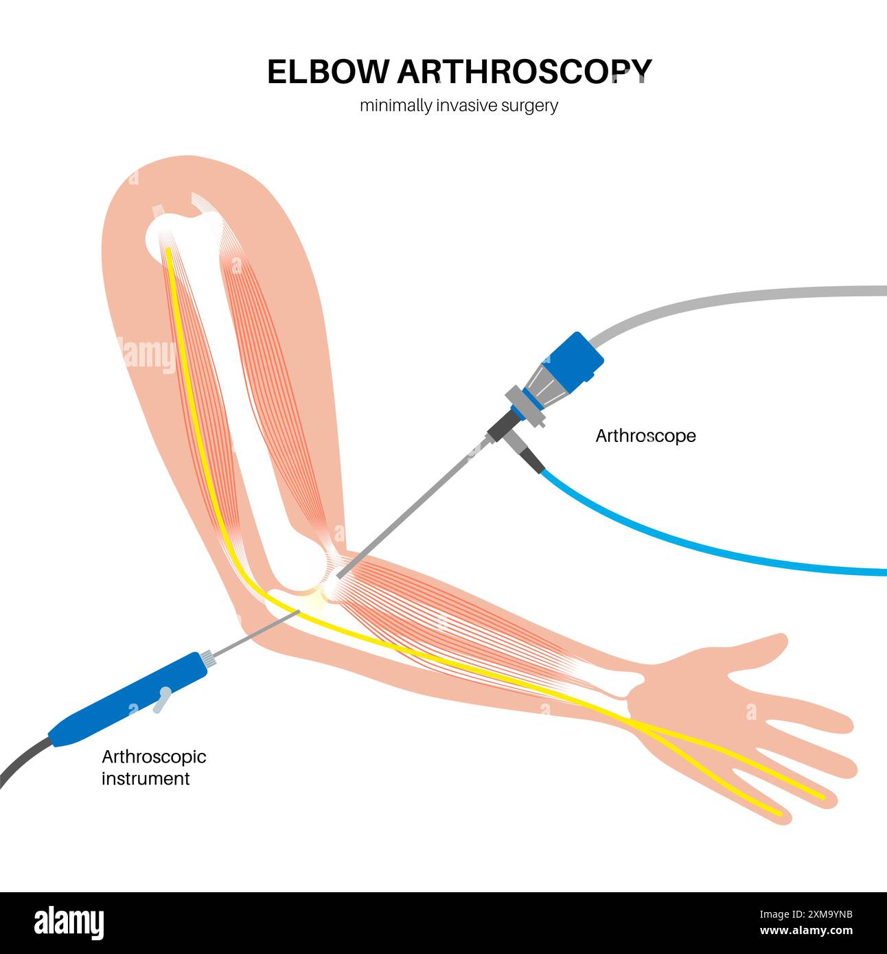 Illustration der Ellenbogenarthroskopie-Chirurgie. Dies ist ein Verfahren zur Diagnose und Behandlung von Gelenkproblemen. Ein Chirurg führt einen schmalen Schlauch, der an einer Glasfaser-Videokamera befestigt ist, durch einen kleinen Schnitt ein. Stockfoto