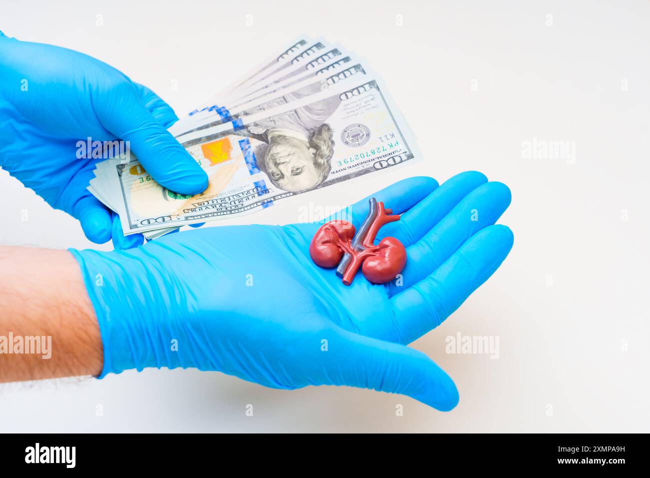 Die Hand trägt blaue Handschuhe hält Geld neben einem Nierenmodell und symbolisiert medizinische Probleme oder wirtschaftliche Faktoren im Zusammenhang mit der Gesundheit. Visuelle Metapher für ihn Stockfoto