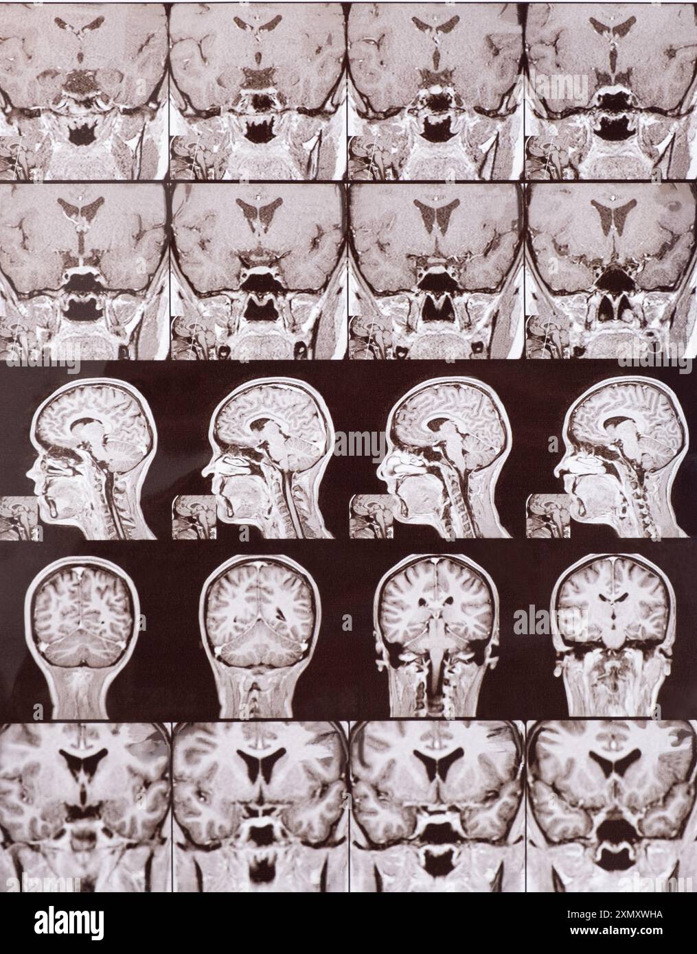 Magnetresonanztomographie des Kopfes eines gesunden Menschen, Bild der Hypophyse. Stockfoto